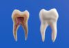 How Long Does Wisdom Teeth Recovery Take Everything You Need to Know