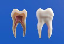 How Long Does Wisdom Teeth Recovery Take Everything You Need to Know