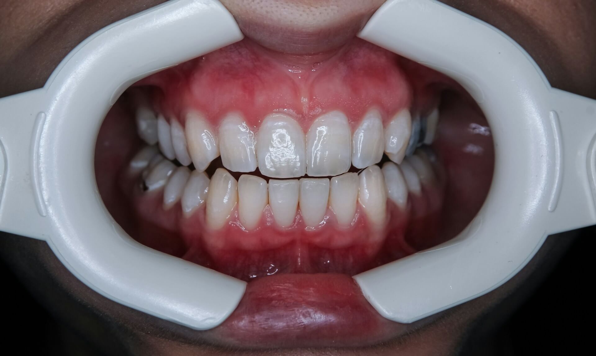 How to Speed Up Wisdom Teeth Recovery