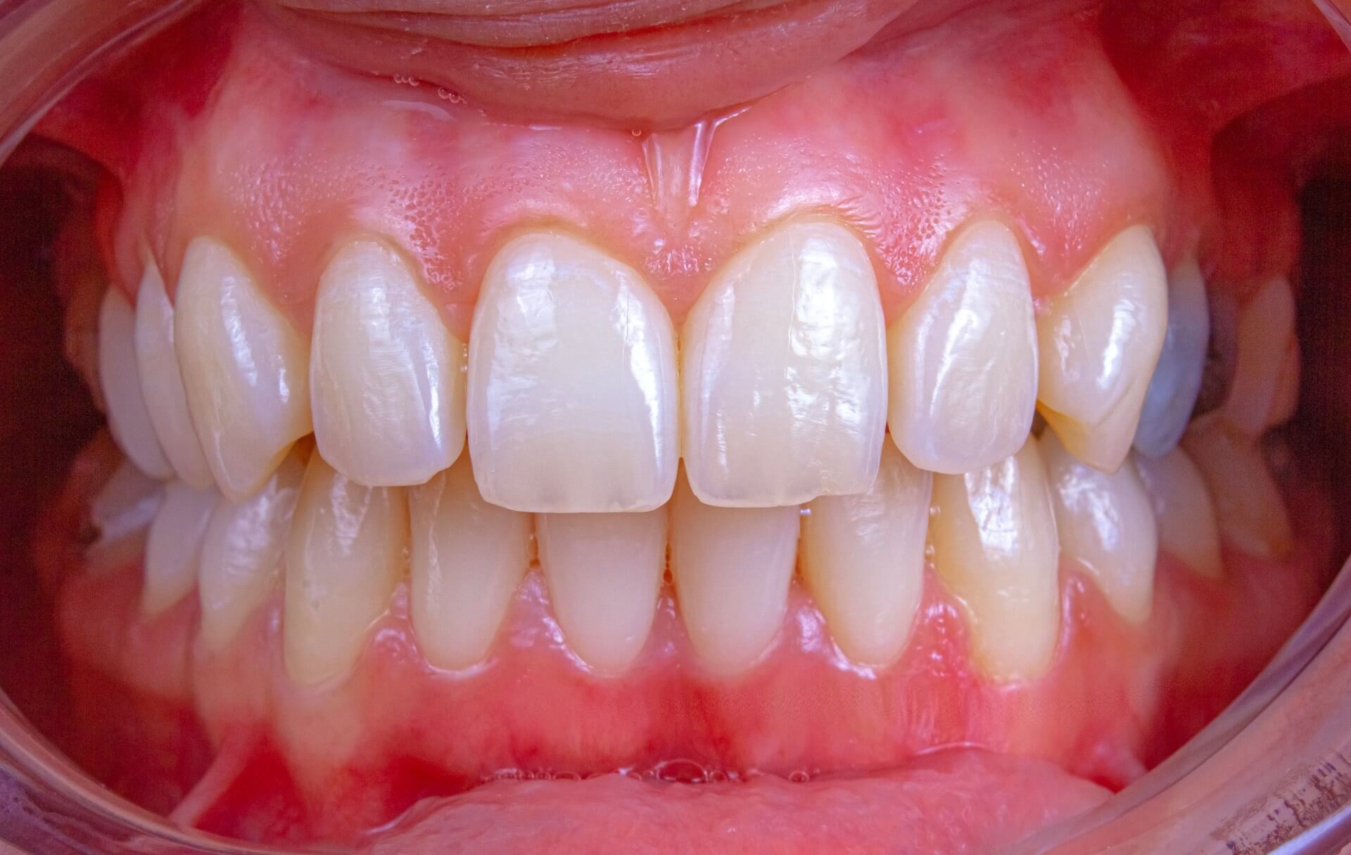 How Long Does Wisdom Teeth Recovery Take for Different Ages