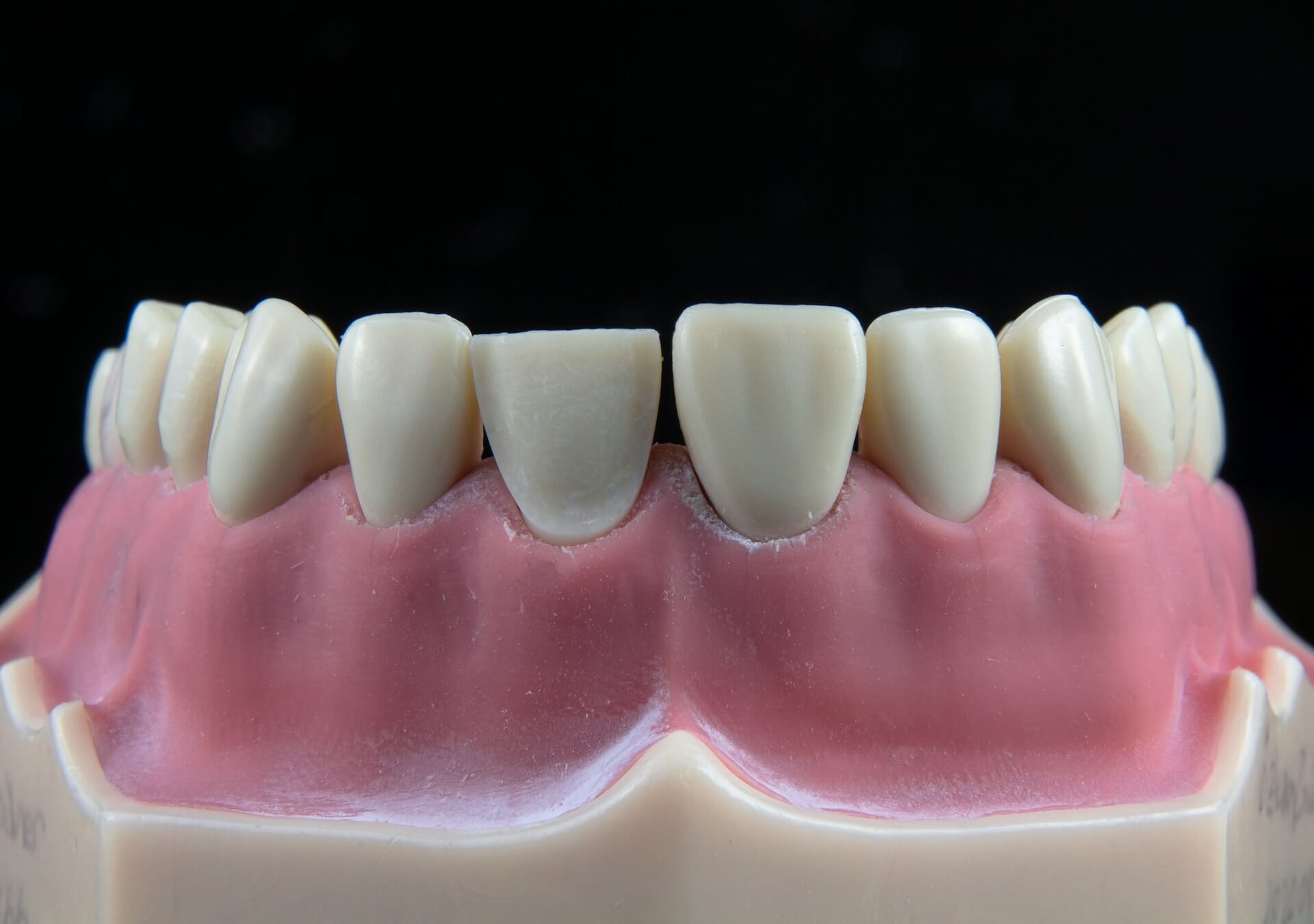 Use ice packs on your cheeks for the first 24 hours. Painkillers prescribed by your dentist will help manage discomfort.