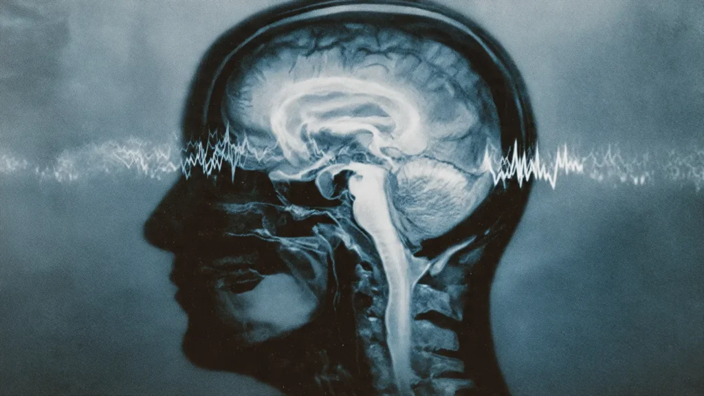 Understanding Mild Cognitive Impairment